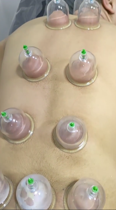 Case Study 6 - Cupping Therapy